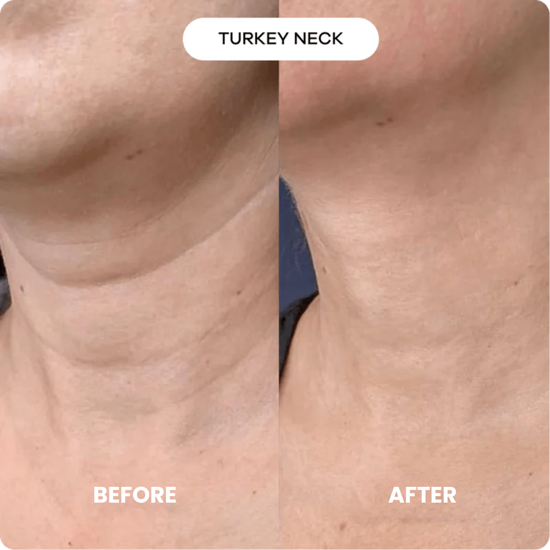 Luxe Micro Infusion System™