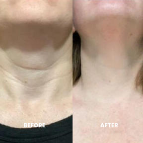 Luxe Micro Infusion System™